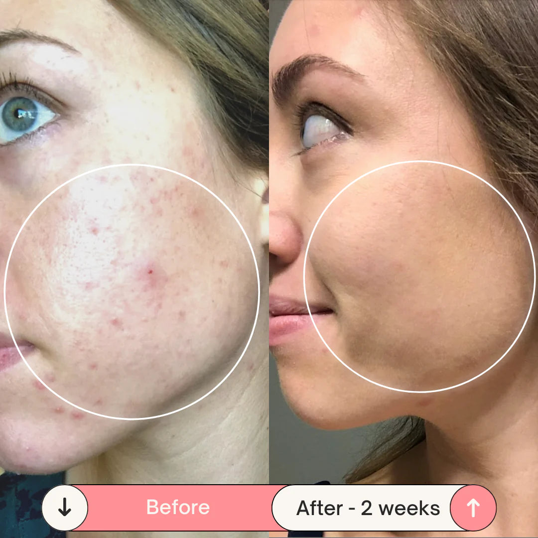 Professional High Frequency Wand